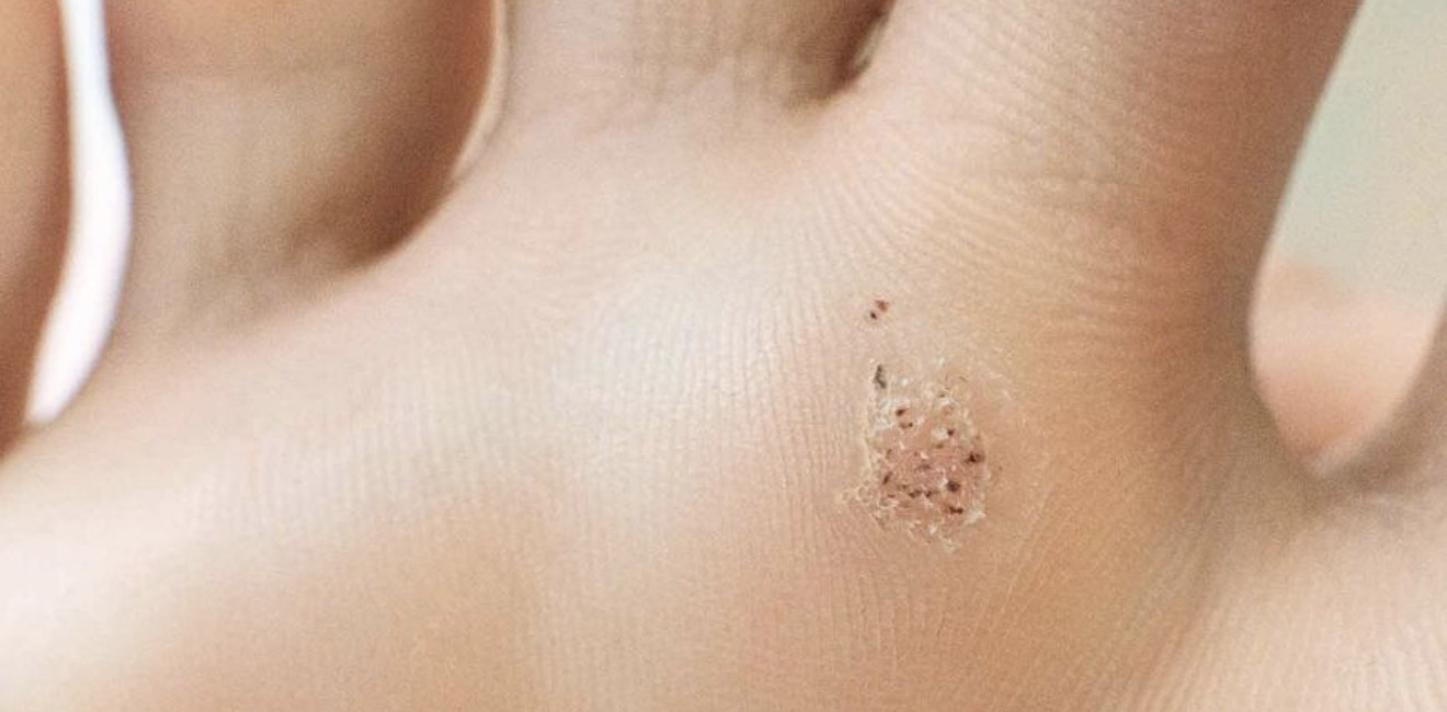 Fotvorter behandling