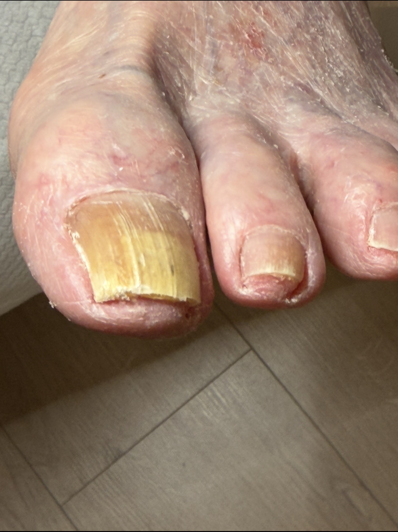 Neglesopp behandling