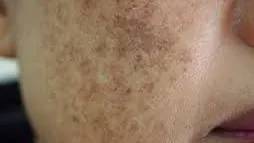 Fjerning av pigmentflekker med laser