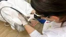 Fjerning av neglesopp med laser