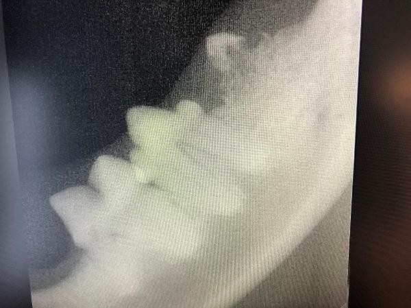 Tannresorpsjon (TR): På bildet ser man røntgen av to friske tenner og skyggen av en TR tann som er i ferd med å gå i oppløsning.